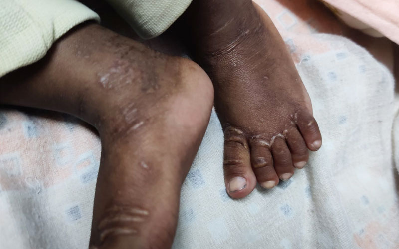 An infant with Alagille syndrome with Xanthomas in lower limb